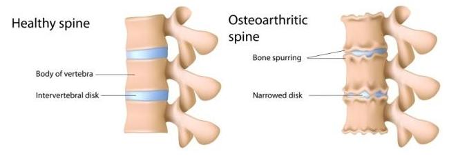 Comparison Healthy Spine to Osteoarthritic Spine